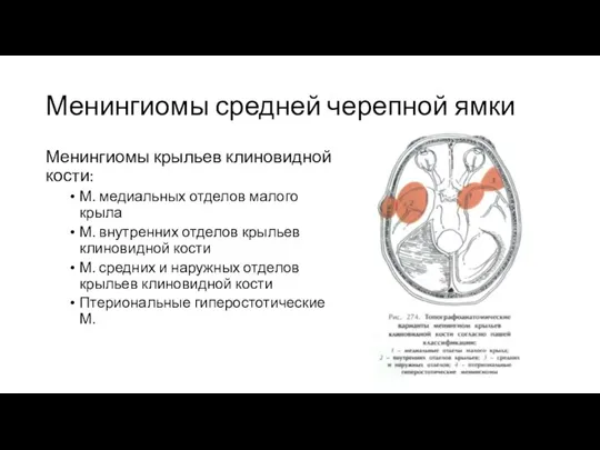 Менингиомы средней черепной ямки Менингиомы крыльев клиновидной кости: М. медиальных отделов