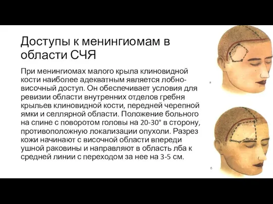 Доступы к менингиомам в области СЧЯ При менингиомах малого крыла клиновидной