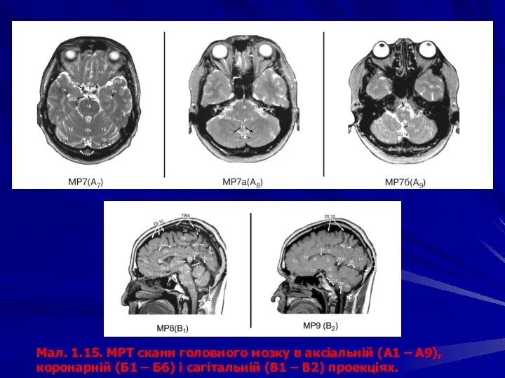 Мал. 1.15. МРТ скани головного мозку в аксіальній (А1 – А9),