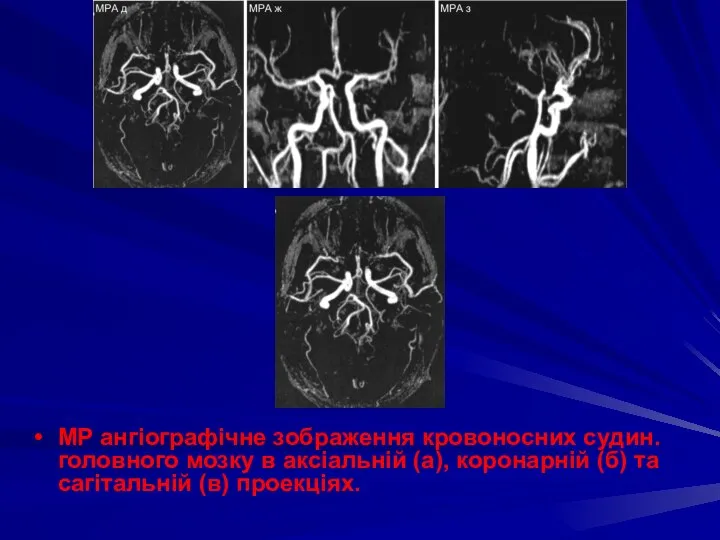 МР ангіографічне зображення кровоносних судин. головного мозку в аксіальній (а), коронарній (б) та сагітальній (в) проекціях.
