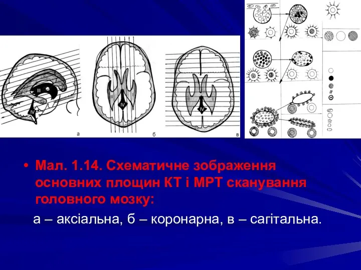 Мал. 1.14. Схематичне зображення основних площин КТ і МРТ сканування головного