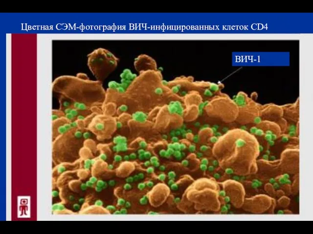 Цветная СЭМ-фотография ВИЧ-инфицированных клеток CD4 ВИЧ-1