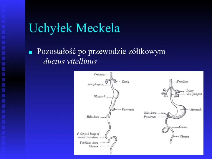 Uchyłek Meckela Pozostałość po przewodzie zółtkowym – ductus vitellinus