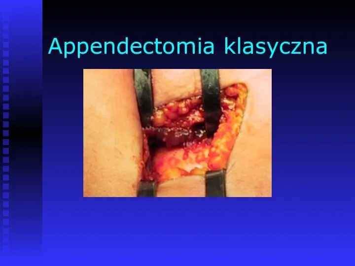 Appendectomia klasyczna