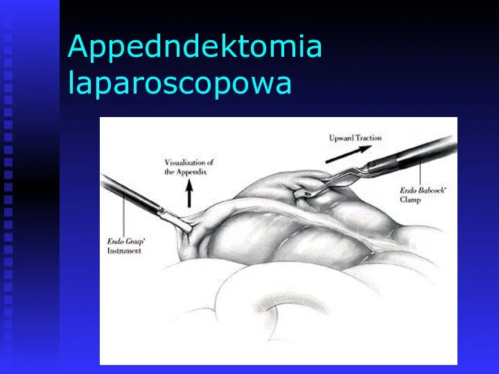 Appedndektomia laparoscopowa