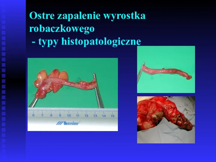 Ostre zapalenie wyrostka robaczkowego - typy histopatologiczne