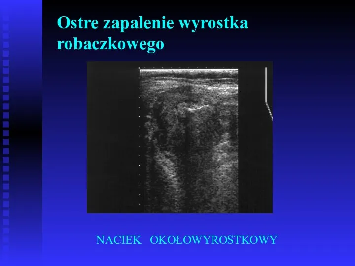 Ostre zapalenie wyrostka robaczkowego NACIEK OKOŁOWYROSTKOWY