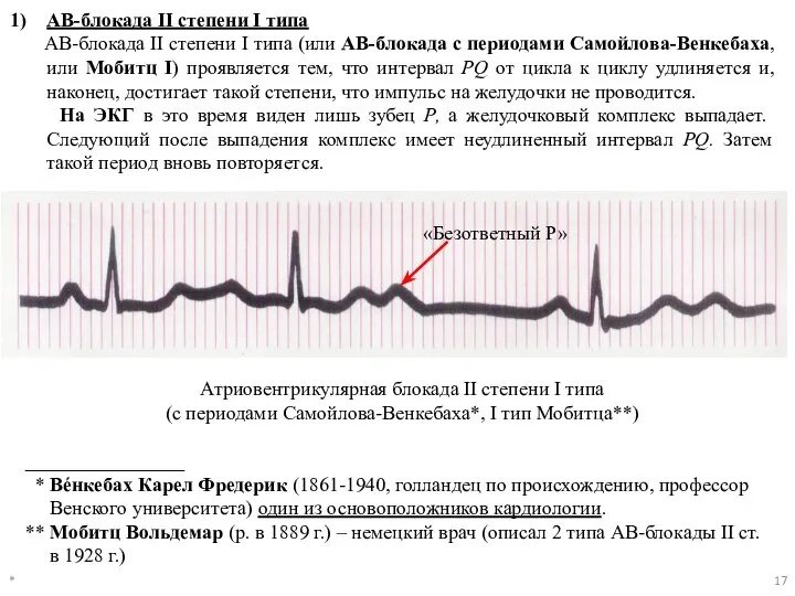 * Атриовентрикулярная блокада II степени I типа (с периодами Самойлова-Венкебаха*, I