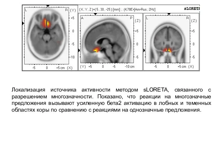 Локализация источника активности методом sLORETA, связанного с разрешением многозначности. Показано, что