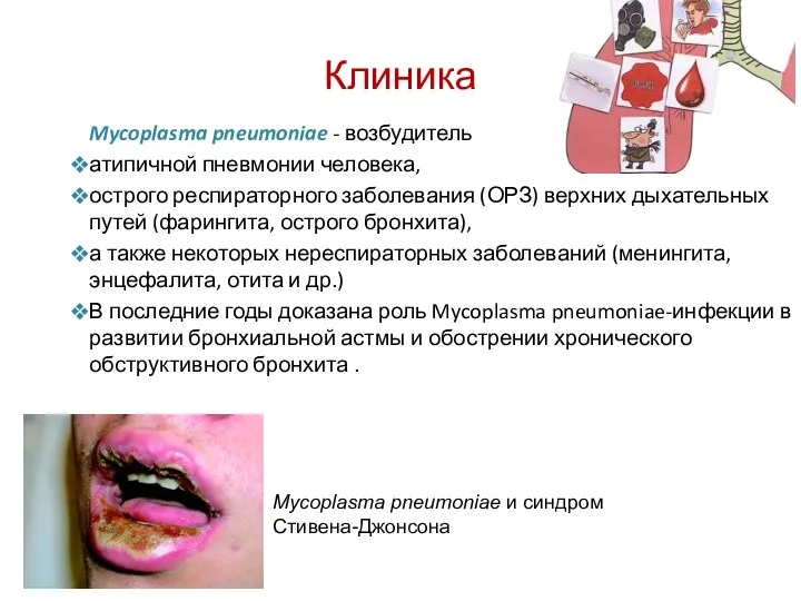 Клиника Mycoplasma pneumoniae - возбудитель атипичной пневмонии человека, острого респираторного заболевания
