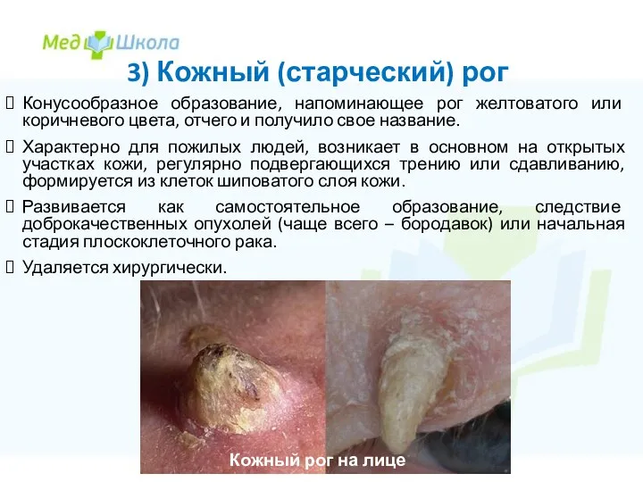 3) Кожный (старческий) рог Конусообразное образование, напоминающее рог желтоватого или коричневого