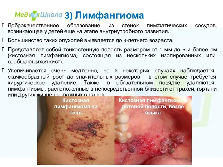 3) Лимфангиома Доброкачественное образование из стенок лимфатических сосудов, возникающее у детей