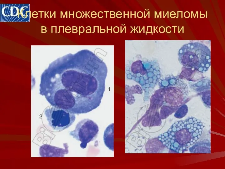 Клетки множественной миеломы в плевральной жидкости