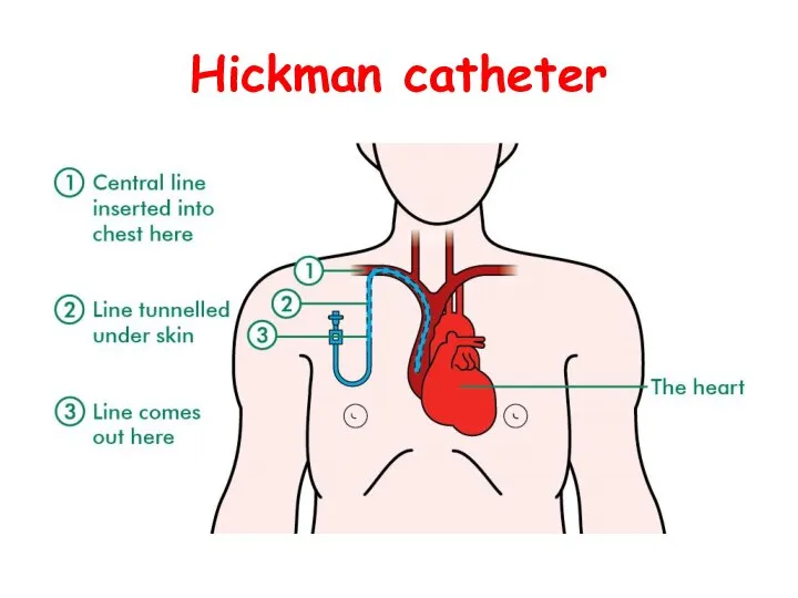 Hickman catheter