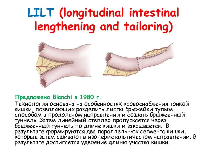 LILT (longitudinal intestinal lengthening and tailoring) Предложена Bianchi в 1980 г.