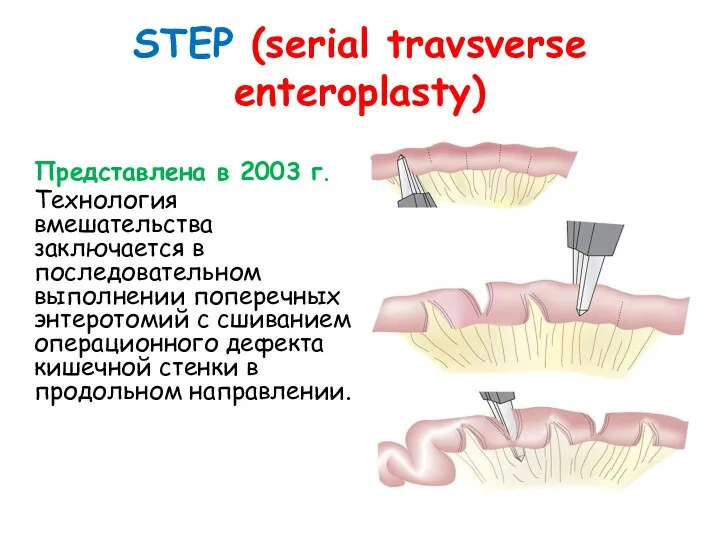 STEP (serial travsverse enteroplasty) Представлена в 2003 г. Технология вмешательства заключается