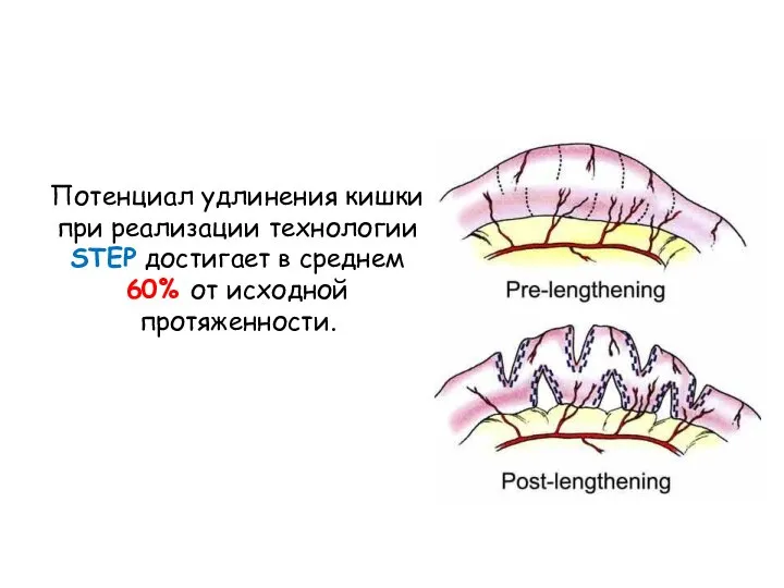 Потенциал удлинения кишки при реализации технологии STEP достигает в среднем 60% от исходной протяженности.
