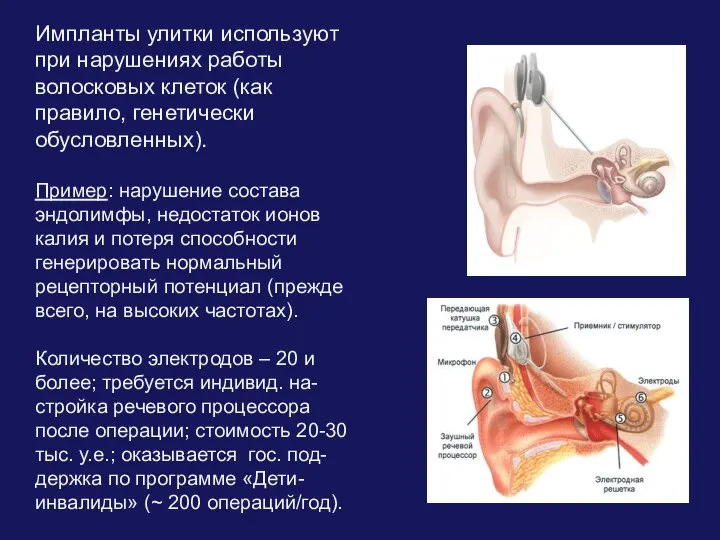 Импланты улитки используют при нарушениях работы волосковых клеток (как правило, генетически