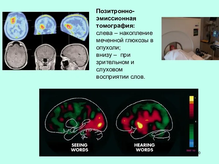 Позитронно-эмиссионная томография: слева – накопление меченной глюкозы в опухоли; внизу –