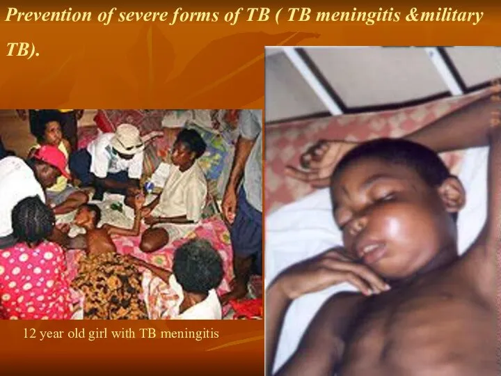 Prevention of severe forms of TB ( TB meningitis &military TB).