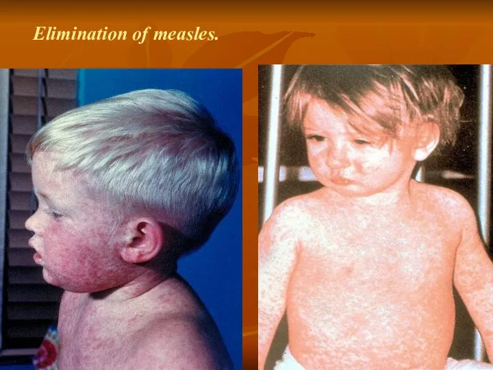 Elimination of measles.