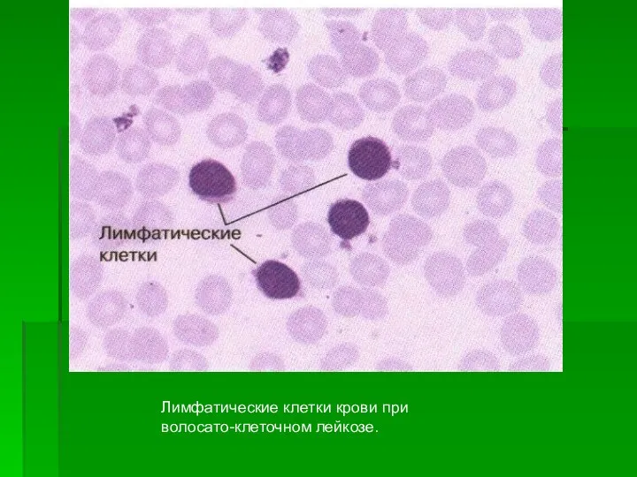 Лимфатические клетки крови при волосато-клеточном лейкозе.