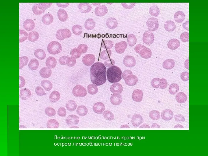 Лейкозные лимфобласты в крови при остром лимфобластном лейкозе
