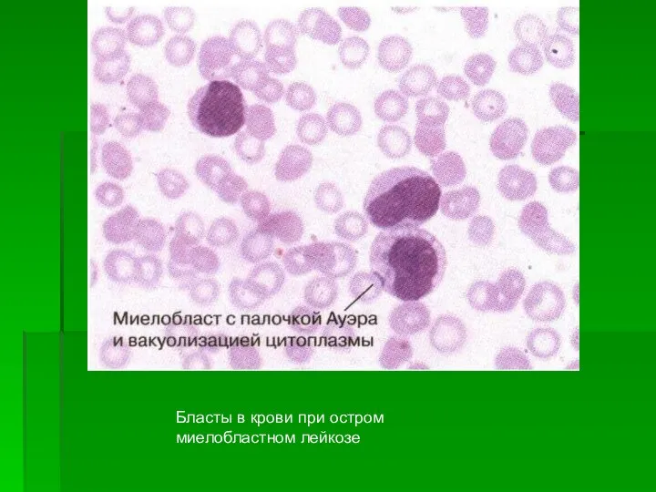 Бласты в крови при остром миелобластном лейкозе