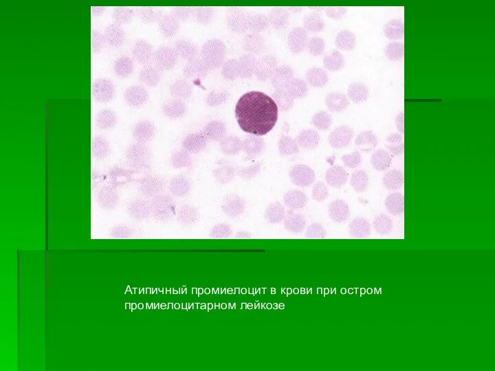 Атипичный промиелоцит в крови при остром промиелоцитарном лейкозе