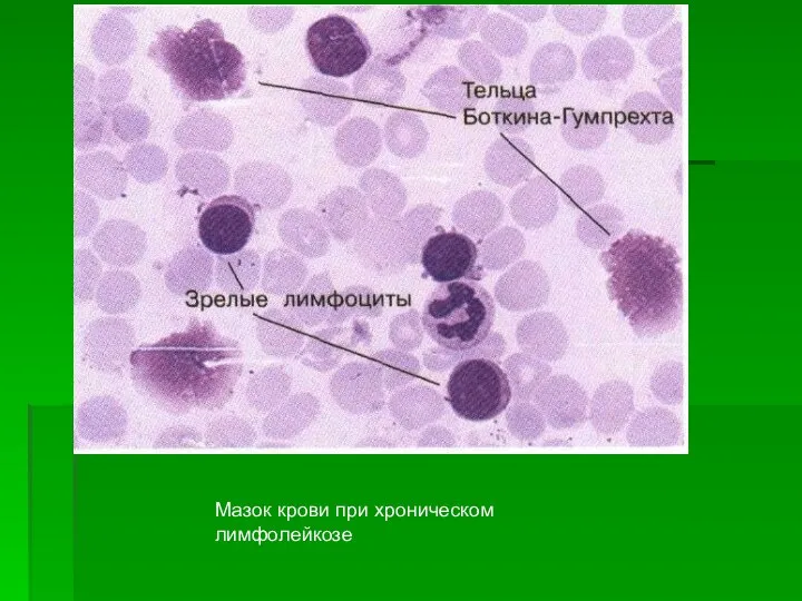 Мазок крови при хроническом лимфолейкозе