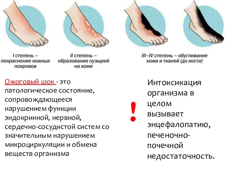 Ожоговый шок - это патологическое состояние, сопровождающееся нарушением функции эндокринной, нервной,