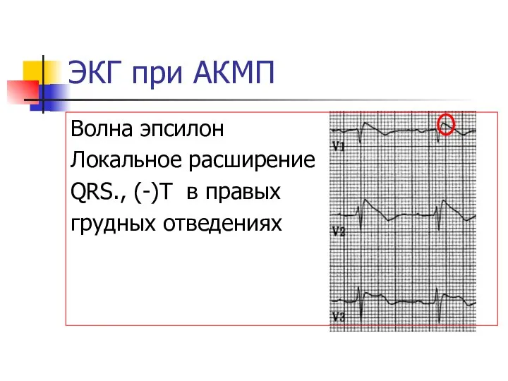 ЭКГ при АКМП Волна эпсилон Локальное расширение QRS., (-)Т в правых грудных отведениях