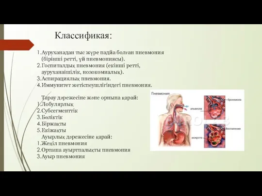 Классификая: Ауруханадан тыс жүре падйа болған пневмония(бірінші ретті, үй пневмониясы). Госпиталдық