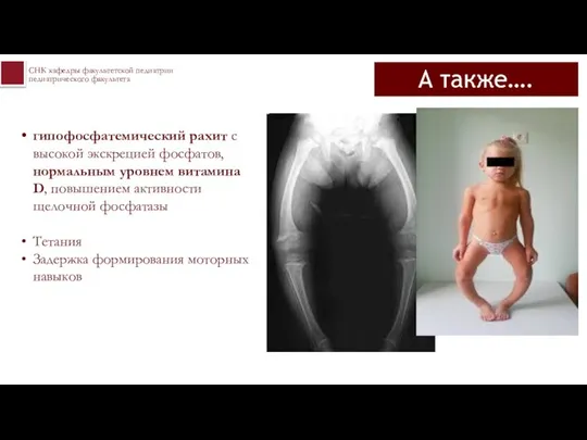 А также…. гипофосфатемический рахит с высокой экскрецией фосфатов, нормальным уровнем витамина