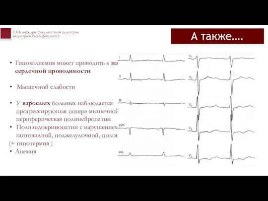 А также…. Гипокалиемия может приводить к нарушениям сердечной проводимости Мышечной слабости