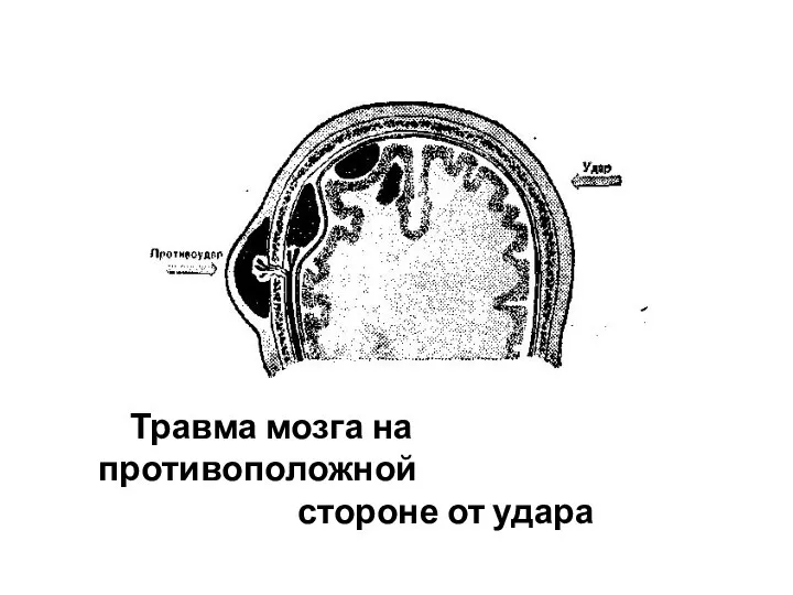 Травма мозга на противоположной стороне от удара