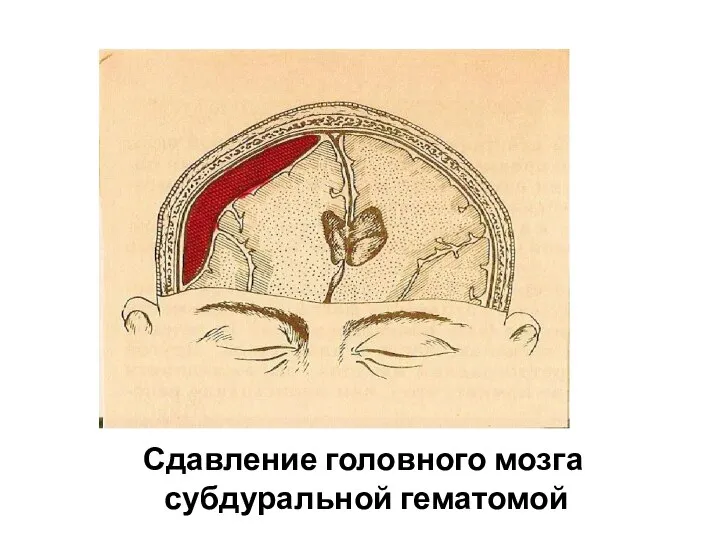 Сдавление головного мозга субдуральной гематомой