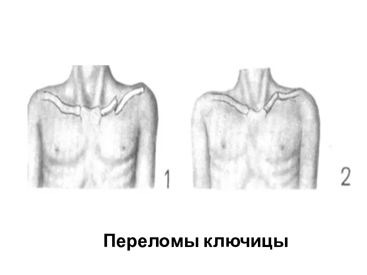 Переломы ключицы