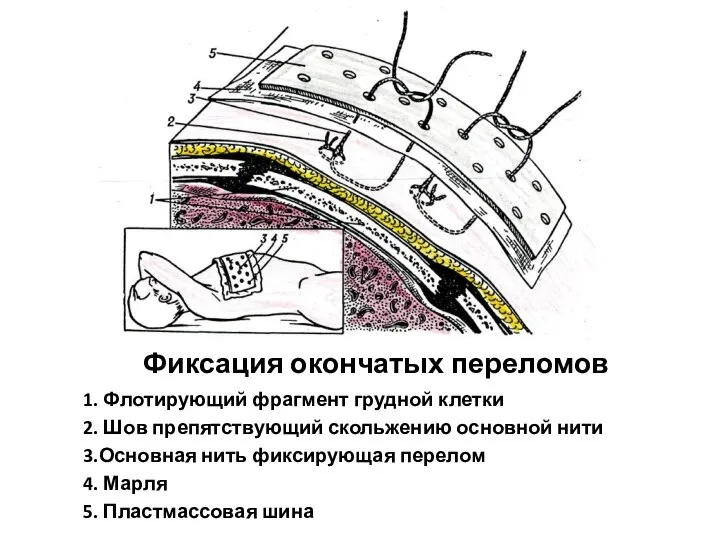 Фиксация окончатых переломов 1. Флотирующий фрагмент грудной клетки 2. Шов препятствующий