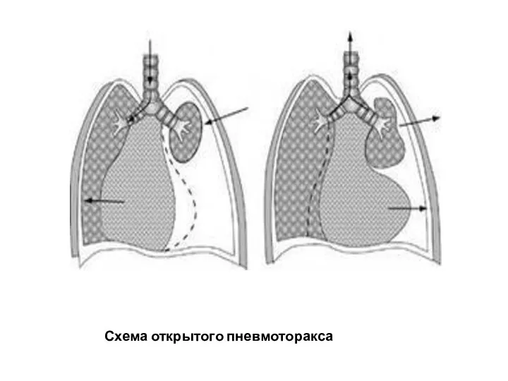 Схема открытого пневмоторакса