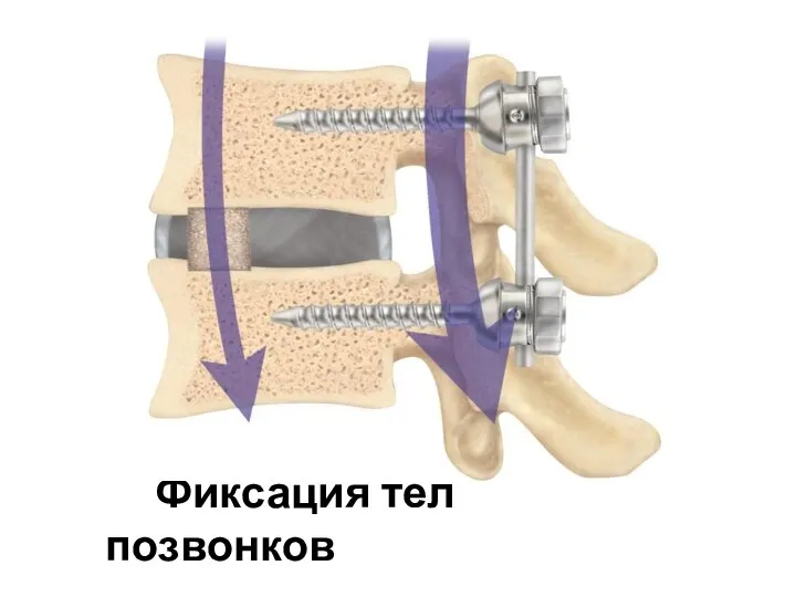 Фиксация тел позвонков