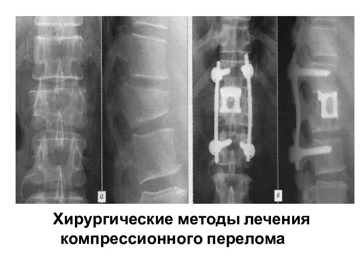 Хирургические методы лечения компрессионного перелома