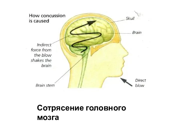 Сотрясение головного мозга