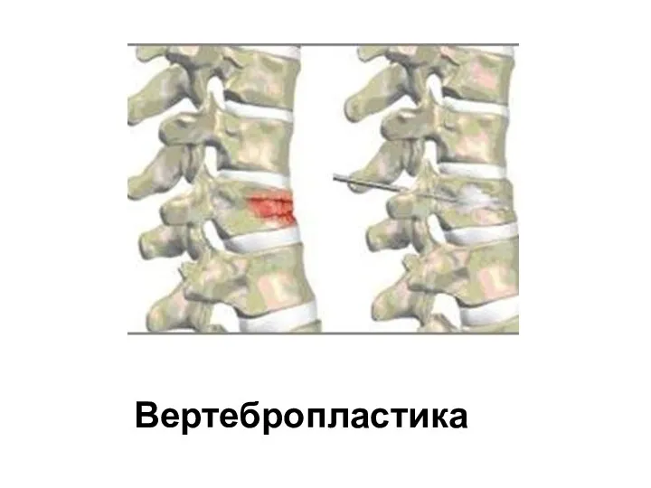 Вертебропластика