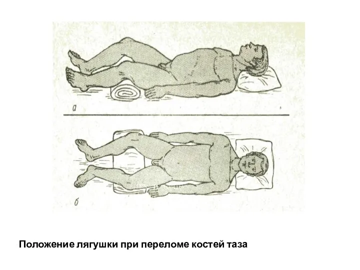 Положение лягушки при переломе костей таза