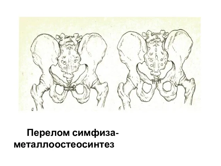 Перелом симфиза- металлоостеосинтез