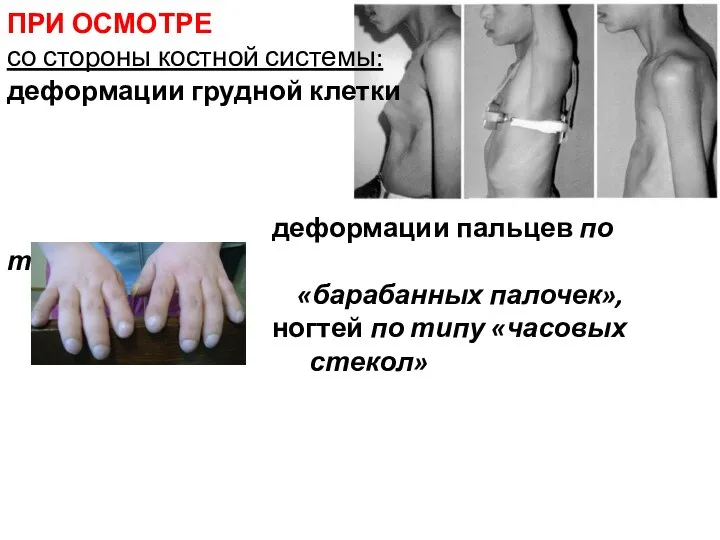 ПРИ ОСМОТРЕ со стороны костной системы: деформации грудной клетки деформации пальцев