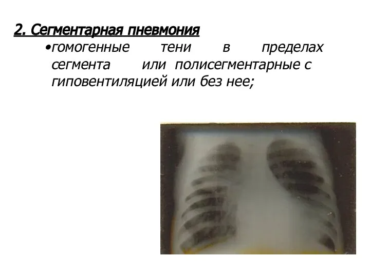 2. Сегментарная пневмония гомогенные тени в пределах сегмента или полисегментарные с гиповентиляцией или без нее;