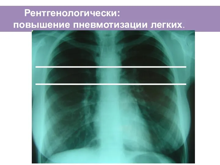 Рентгенологически: повышение пневмотизации легких.