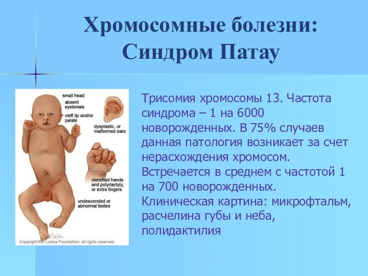 Хромосомные болезни: Синдром Патау Трисомия хромосомы 13. Частота синдрома – 1